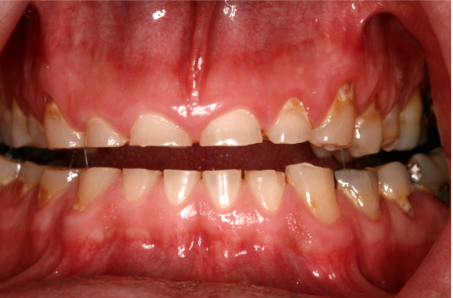 Grinding Of Teeth In Children