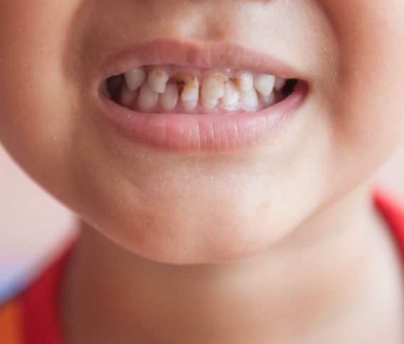 Dental injuries to teeth in children