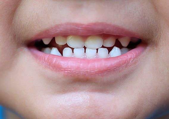 Importance of milk teeth