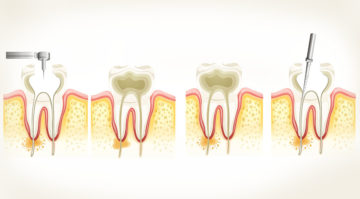 CAN ROOT CANAL TREATMENT BE DONE IN KIDS?